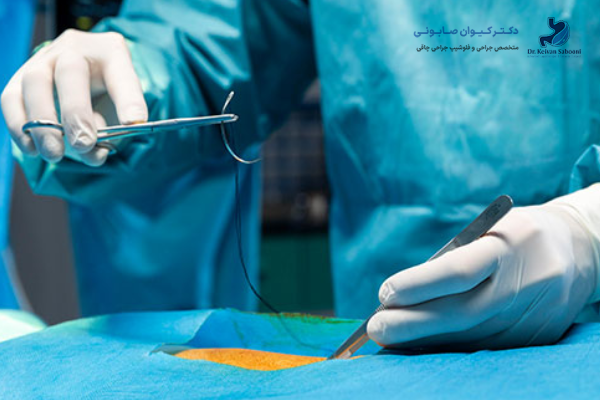 آیا منگنهها در بدن باقی میمانند و خطرناک هستند؟