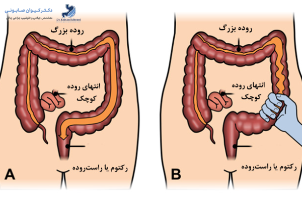 درمان سندروم روده تحریک پذیر