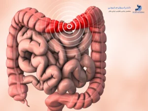سندروم روده تحریک پذیر (IBS)