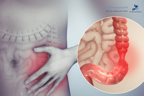 سندروم روده تحریک پذیر چیست؟