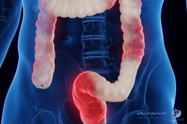 علت سندروم روده تحریک پذیر چیست؟