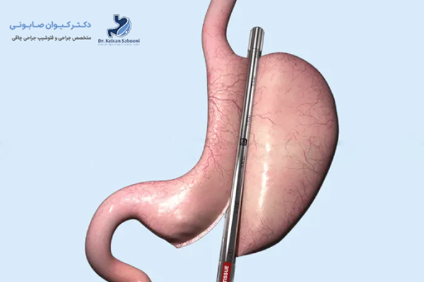 مزایای استفاده از منگنه در اسلیو معده