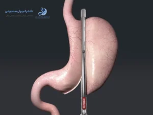 منگنه اسلیو معده