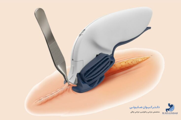 منگنه اسلیو معده چیست؟