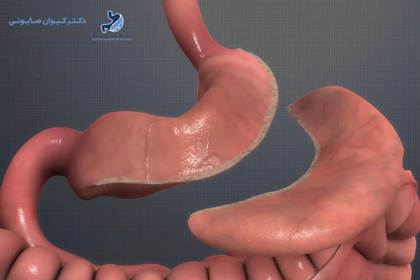 هزینه اسلیو معده در بیمارستان خصوصی سنندج