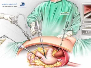 هزینه اسلیو معده در سنندج