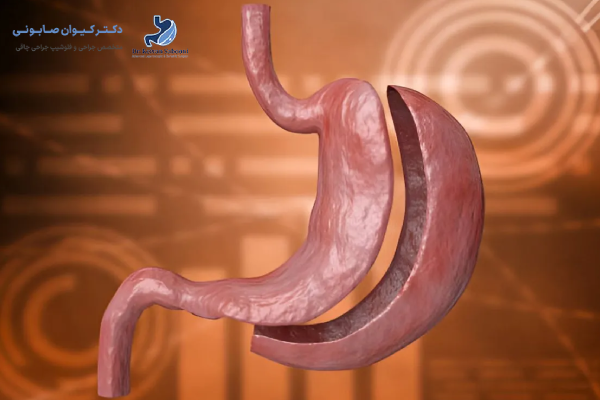 هزینه اسلیو معده در سنندج چقدر است؟